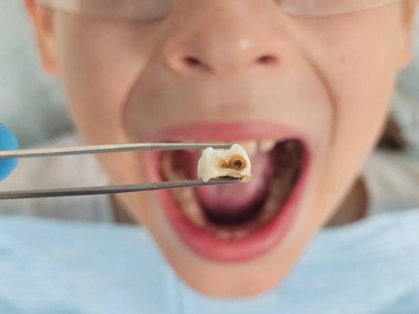 Best Emergency Dentist for Lost Fillings or Crowns in Key Biscayne, FL